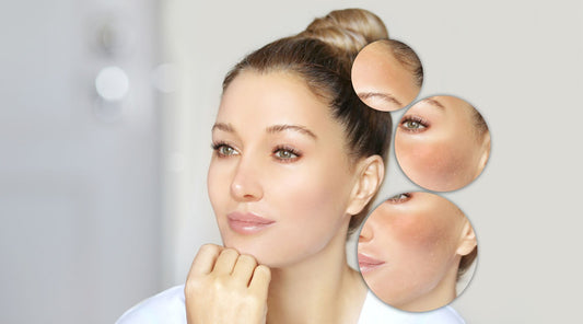 Hyperpigmentation – Cause, Prevention & Treatment