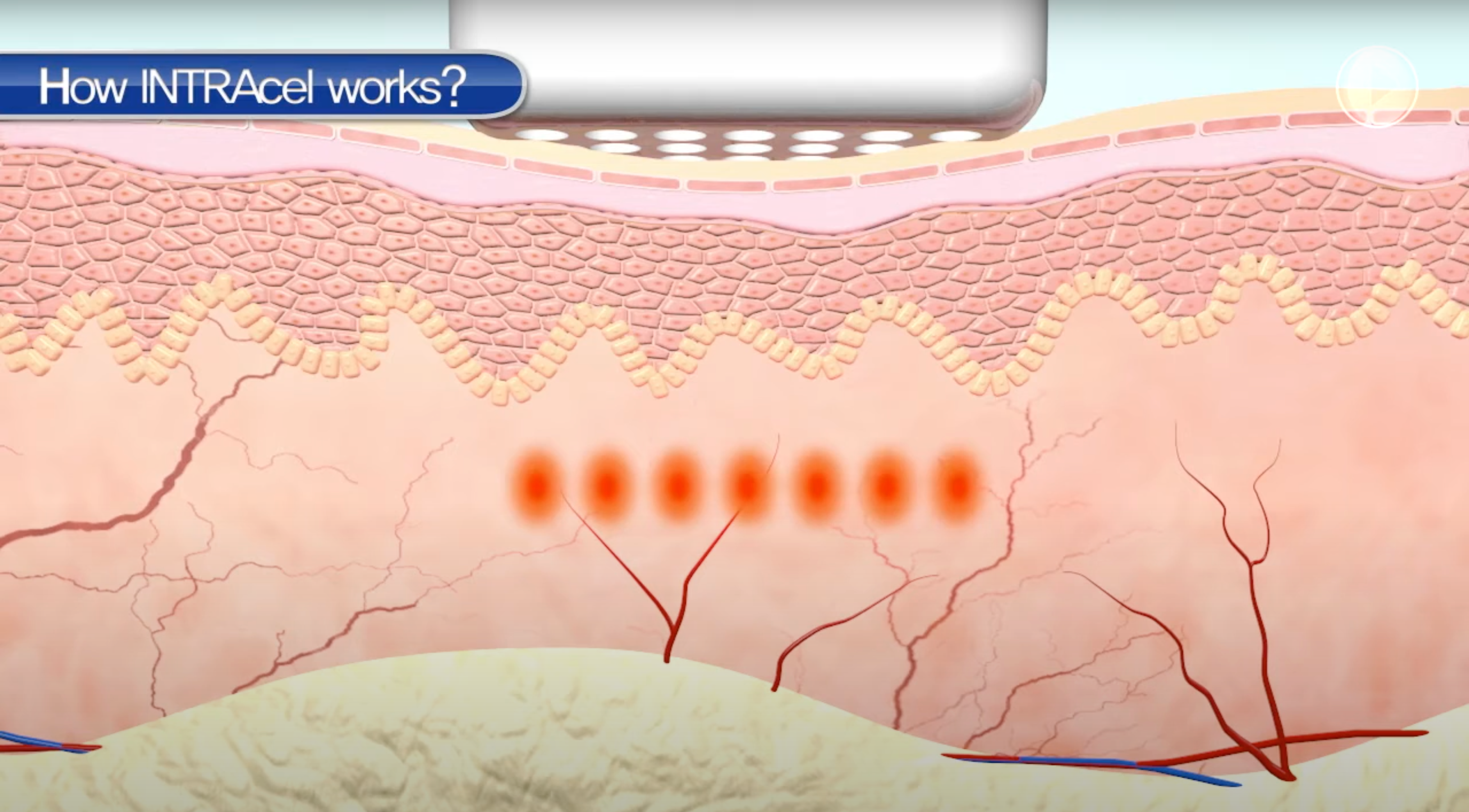 Load video: Intracel RF Microneedle video