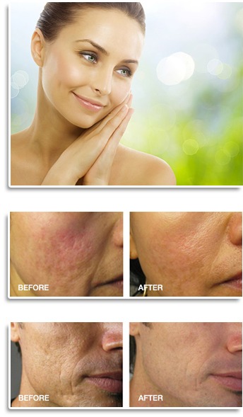 Acne Scarring Treatment