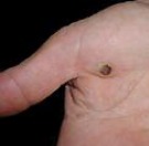 remove wart from hand