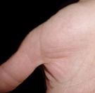 remove wart from hand