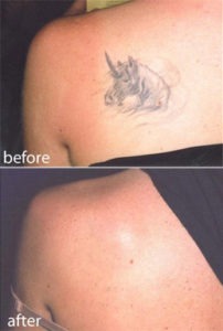 Laser Tattoo Removal Before After