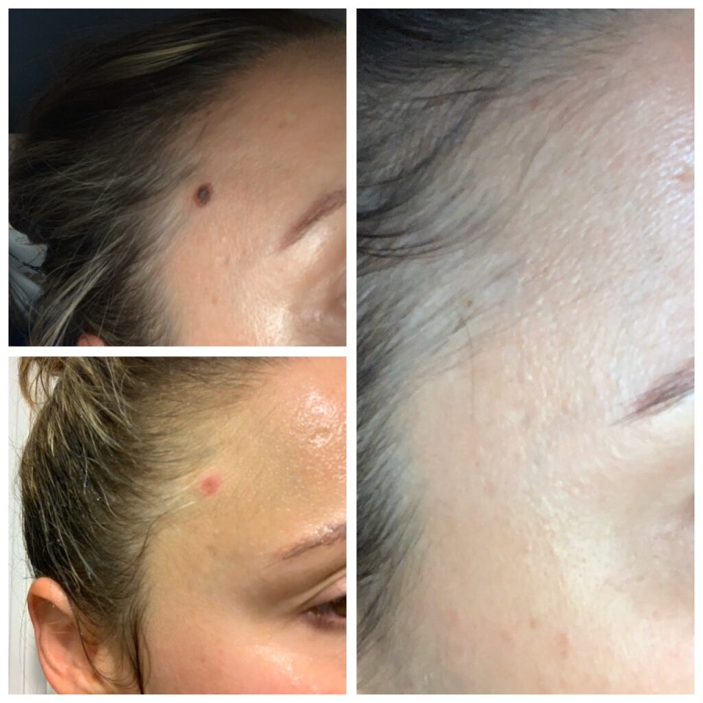 cryoprobe-before-after